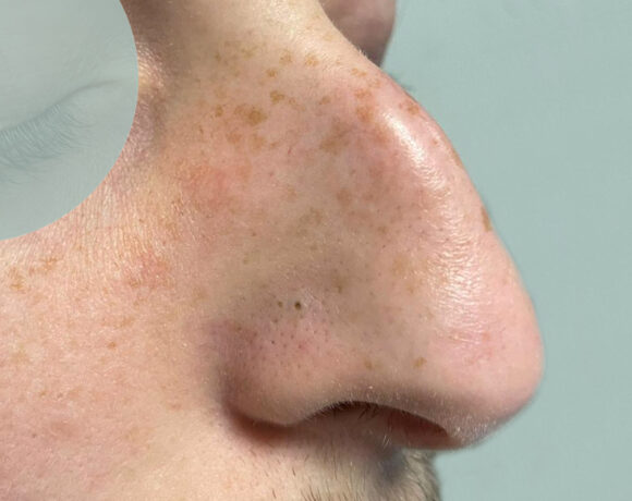 Storie vere: la rinosettoplastica di Giacomo