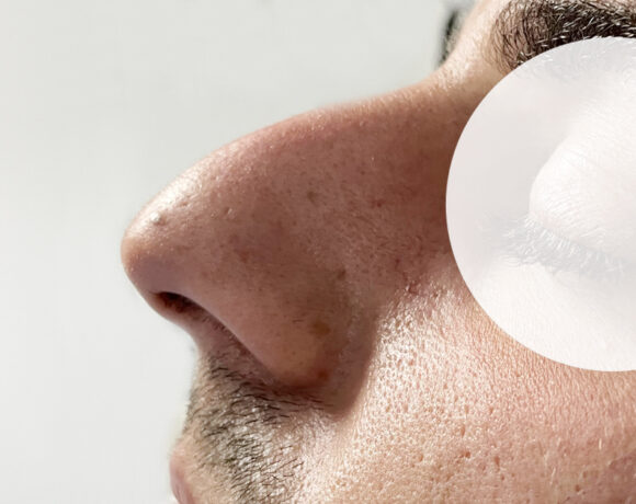 La turbinoplastica e rinosettoplastica di Marco